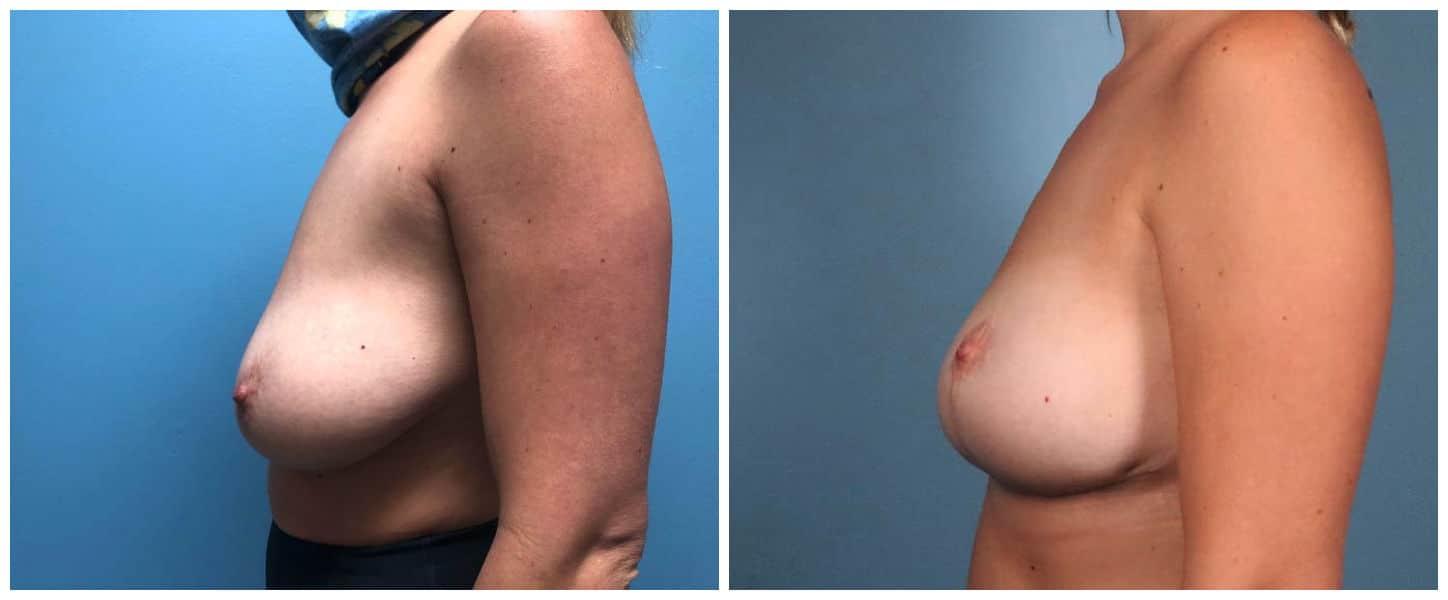 Dr. Ashley Steinberg - Trouvaille Aesthetics & Plastic Surgery breast lift result — Houston, TX