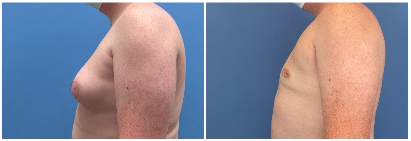Dr. Ashley Steinberg - Trouvaille Aesthetics & Plastic Surgery gynecomastia result — Houston, TX
