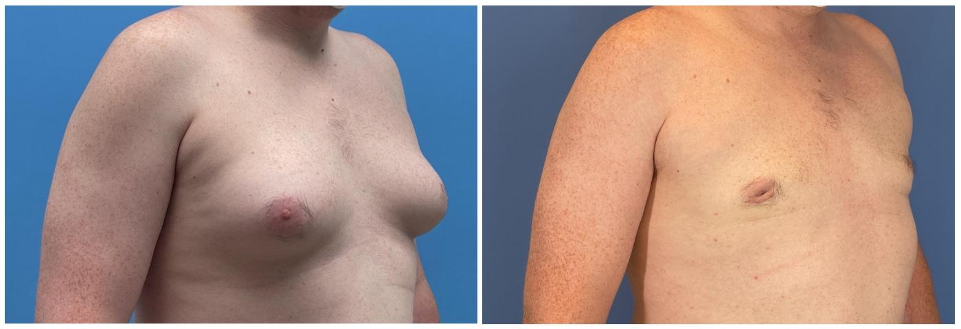 Dr. Ashley Steinberg - Trouvaille Aesthetics & Plastic Surgery gynecomastia result — Houston, TX
