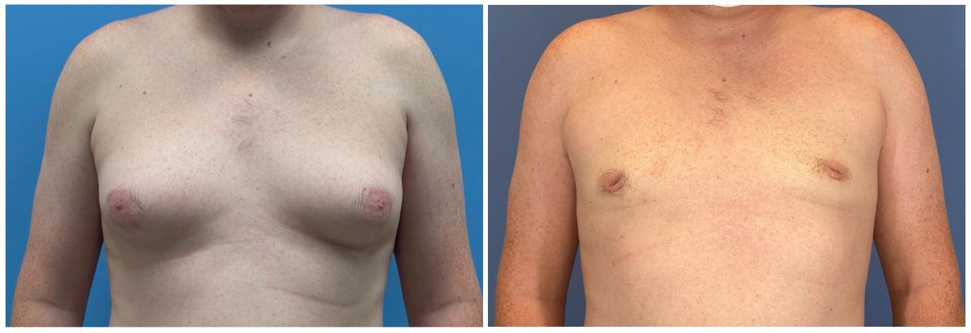 Dr. Ashley Steinberg - Trouvaille Aesthetics & Plastic Surgery gynecomastia result — Houston, TX