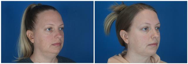 Neck Liposuction result at Dr. Ashley Steinberg - Trouvaille Aesthetics & Plastic Surgery in Houston, TX