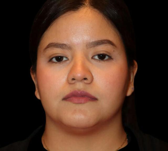 Neck Liposuction before at Dr. Kristy Hamilton in Houston, TX