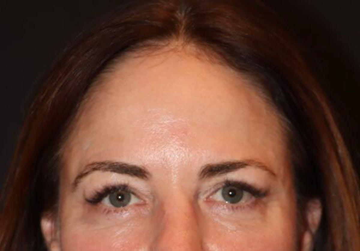 Dr. Kristy Hamilton blepharoplasty after — Houston, TX