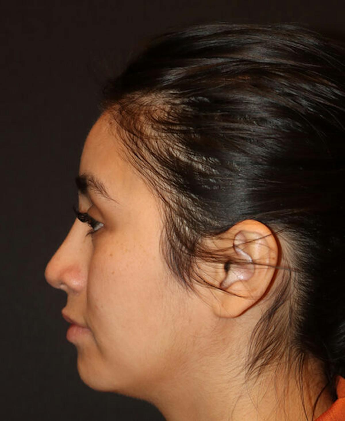 Dr. Kristy Hamilton rhinoplasty after — Houston, TX