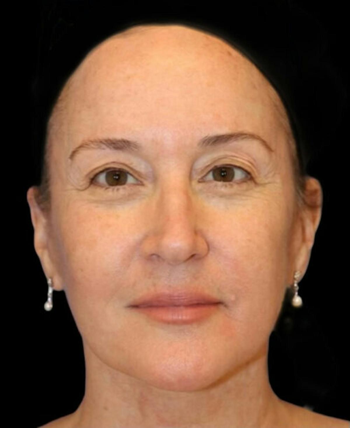 Dr. Kristy Hamilton facelift after — Houston, TX
