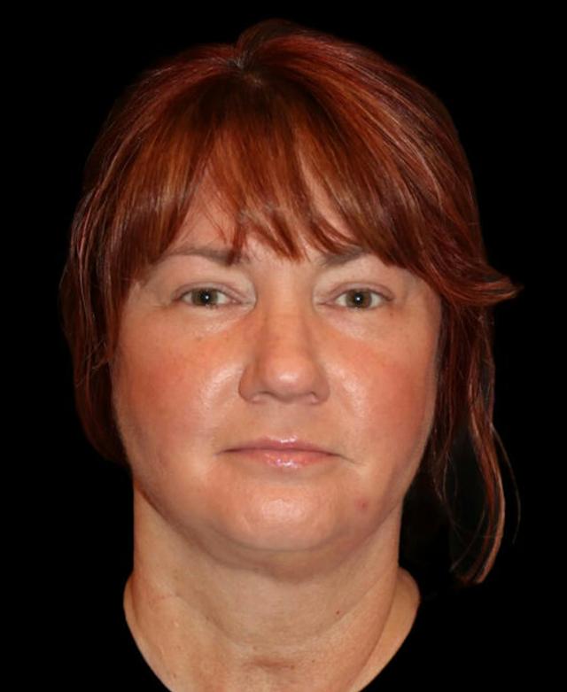 Facelift before at Dr. Kristy Hamilton in Houston, TX