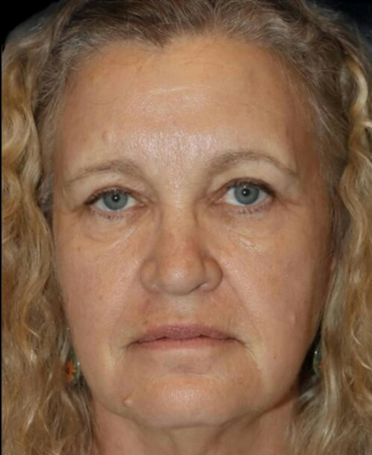 Dr. Kristy Hamilton blepharoplasty after — Houston, TX