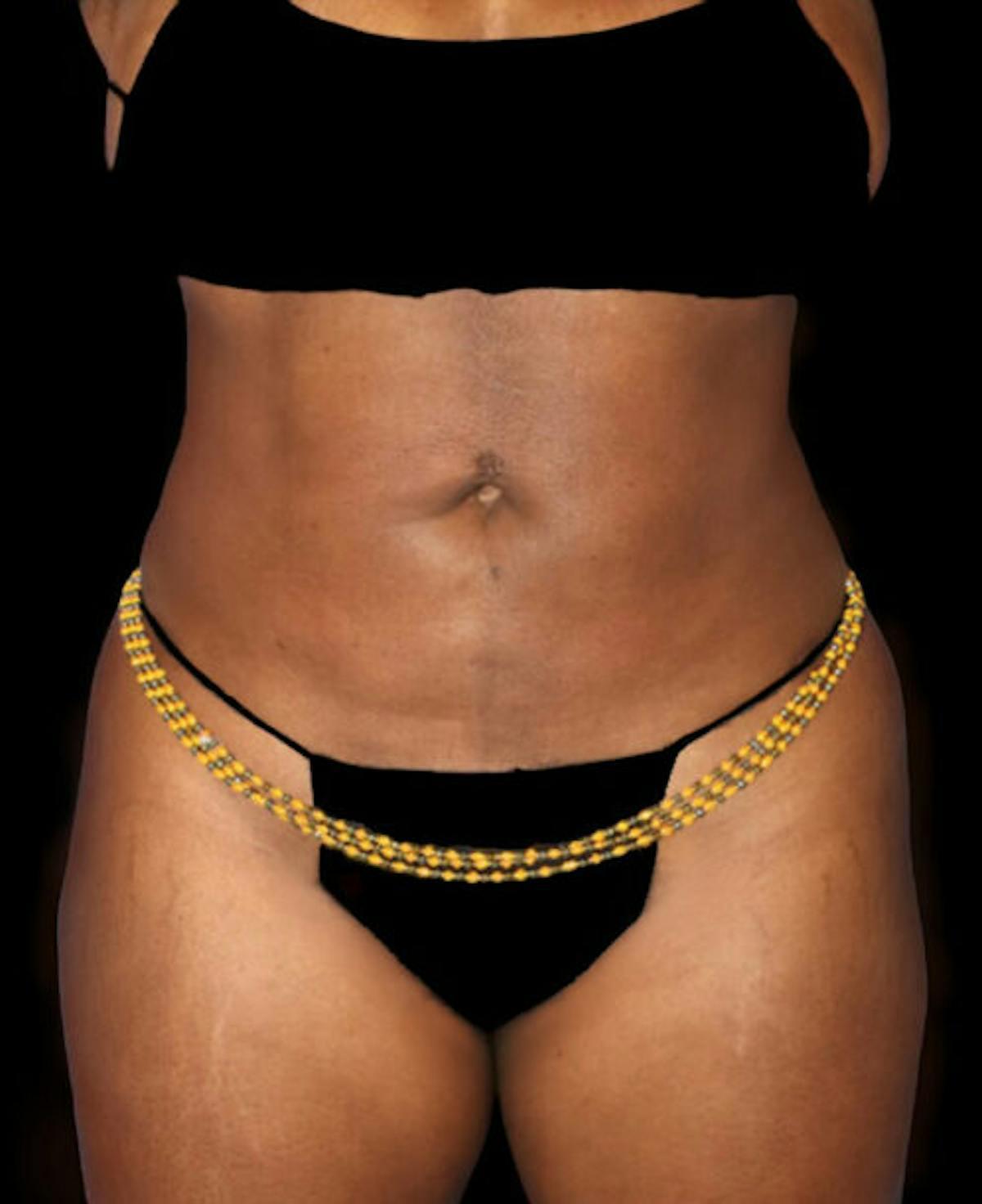 Dr. Kristy Hamilton liposuction after — Houston, TX