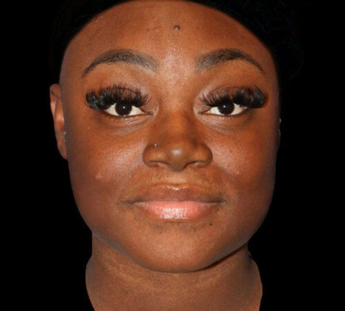Dr. Kristy Hamilton submental liposuction after — Houston, TX