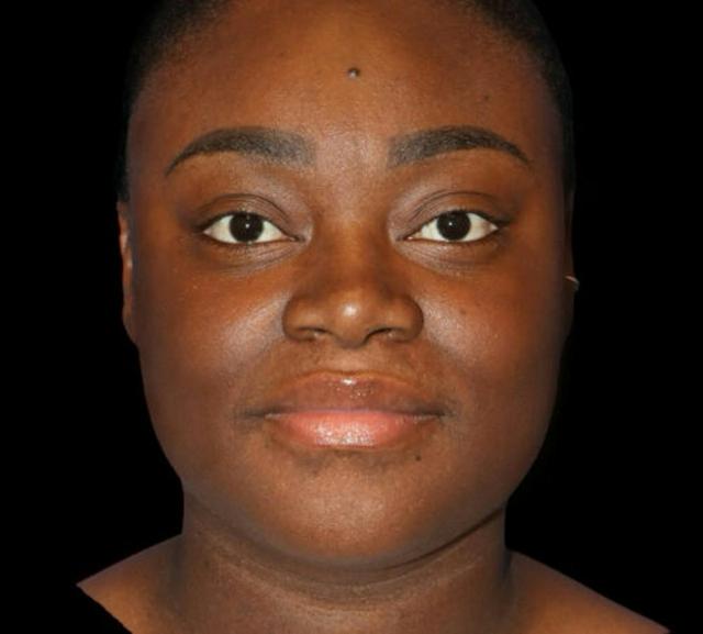 Neck Liposuction before at Dr. Kristy Hamilton in Houston, TX