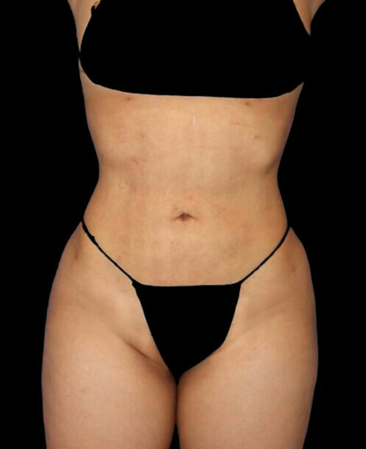 Dr. Kristy Hamilton liposuction after — Houston, TX