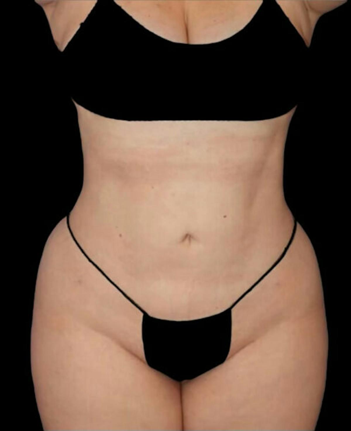 Dr. Kristy Hamilton liposuction after — Houston, TX