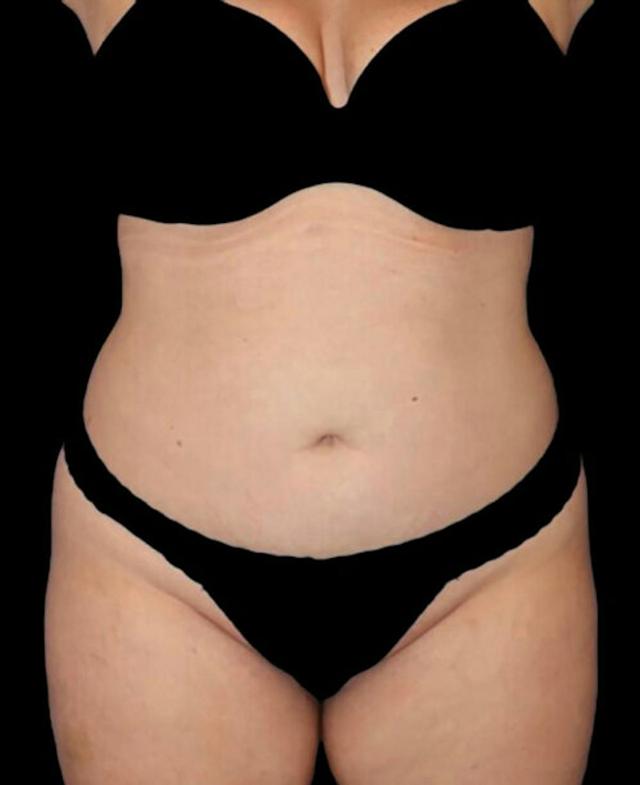Liposuction before at Dr. Kristy Hamilton in Houston, TX
