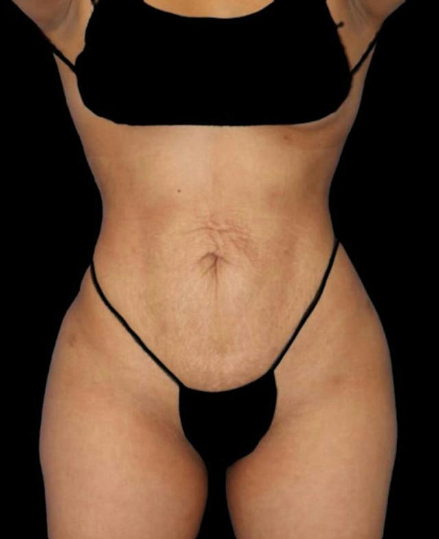 Liposuction after at Dr. Kristy Hamilton in Houston, TX