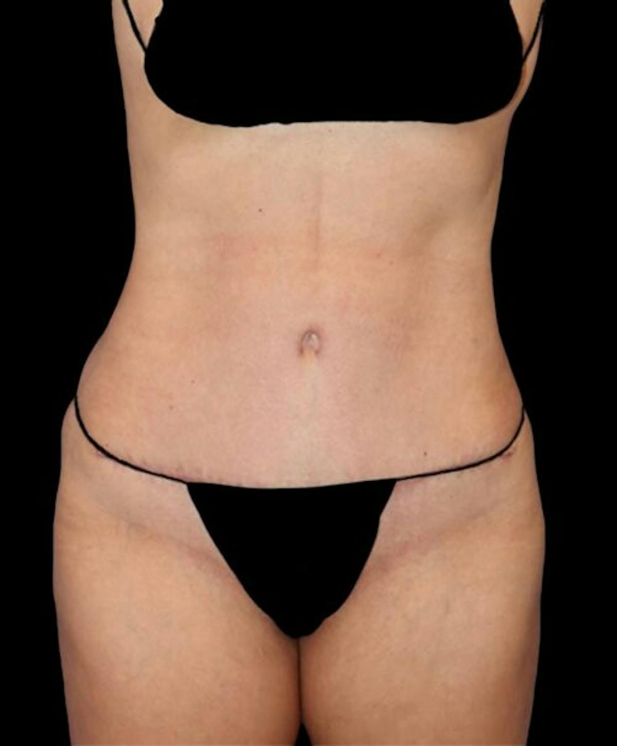 Dr. Kristy Hamilton tummy tuck after — Houston, TX