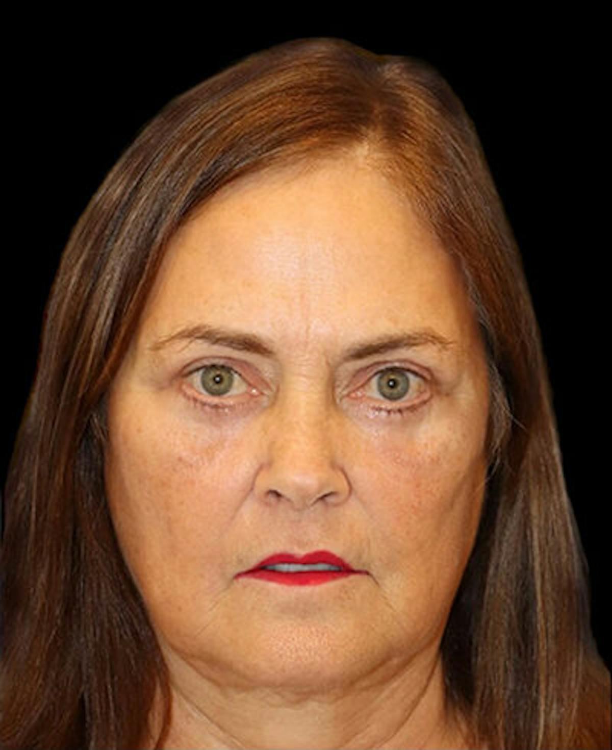 Dr. Kristy Hamilton blepharoplasty after — Houston, TX