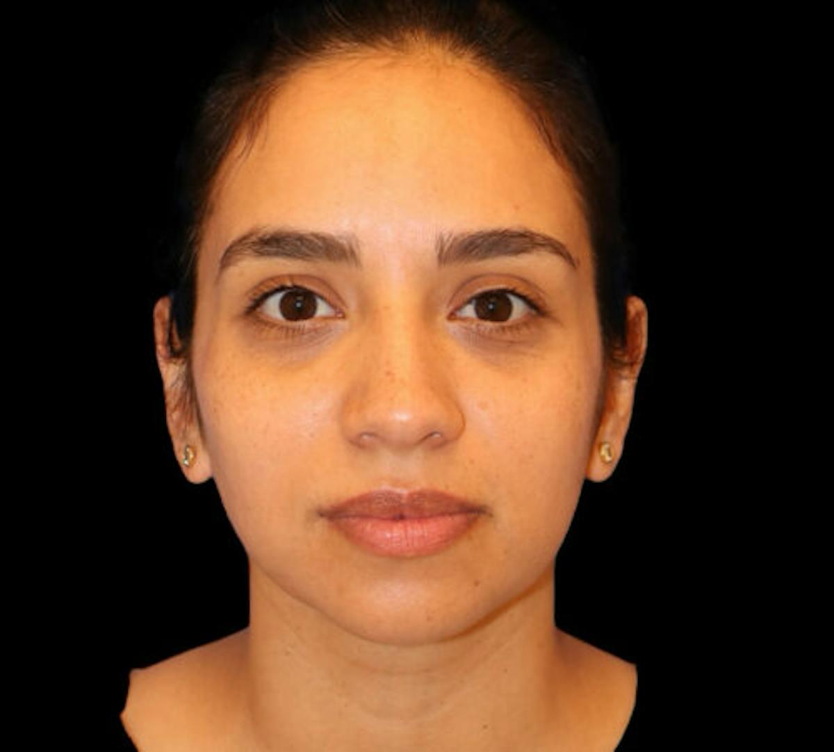 Dr. Kristy Hamilton submental liposuction after — Houston, TX