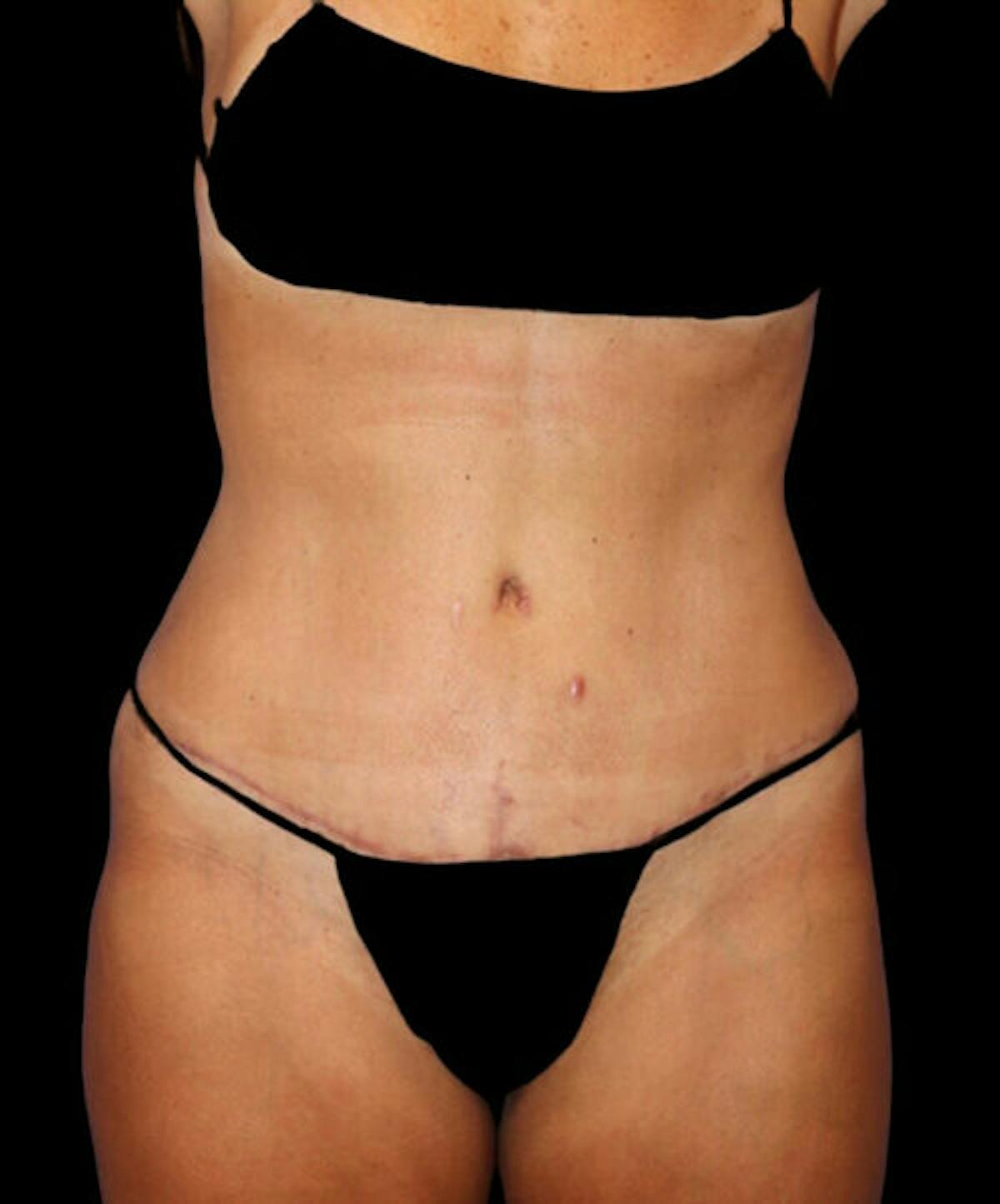 Dr. Kristy Hamilton tummy tuck after — Houston, TX