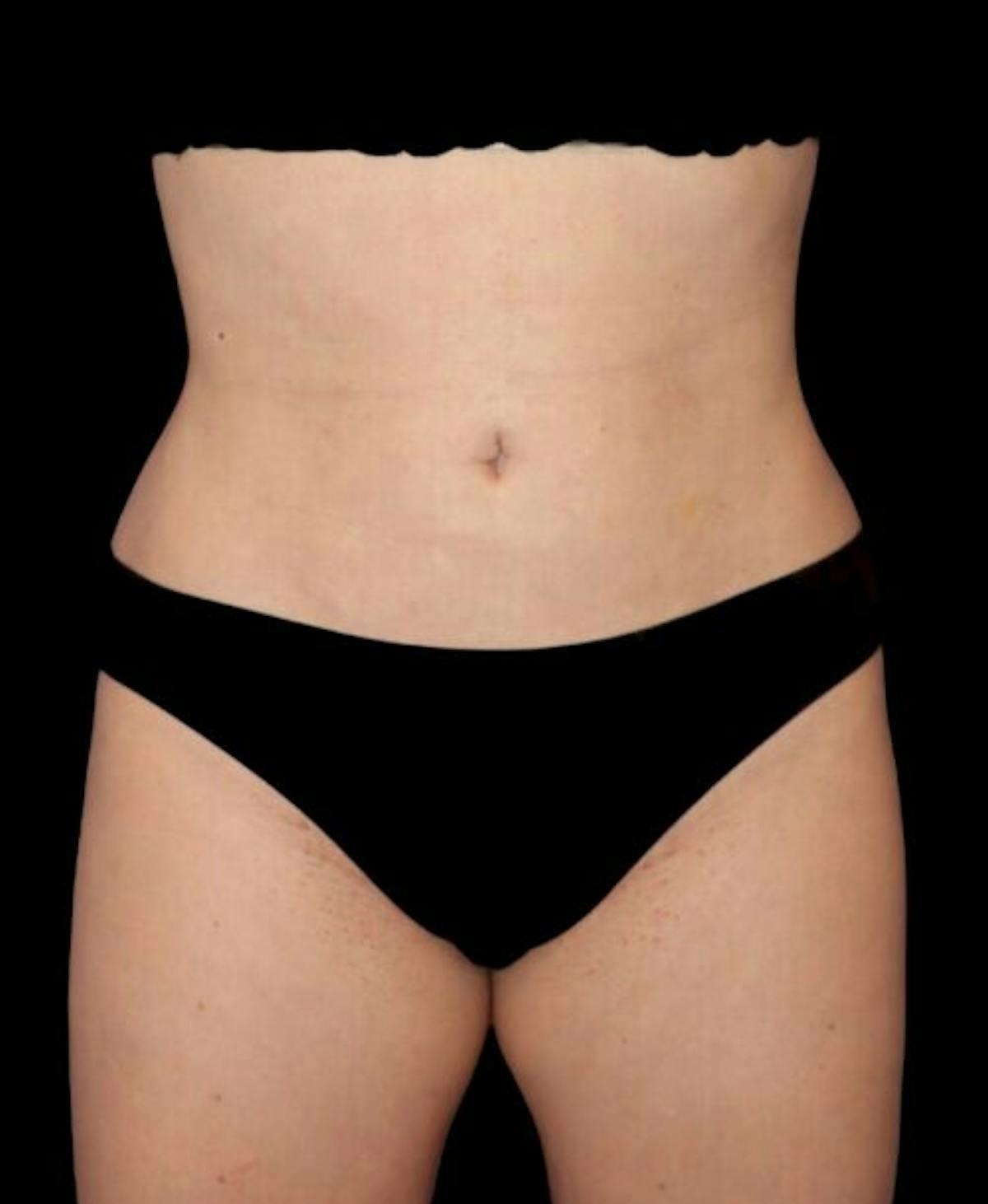 Dr. Kristy Hamilton liposuction after — Houston, TX