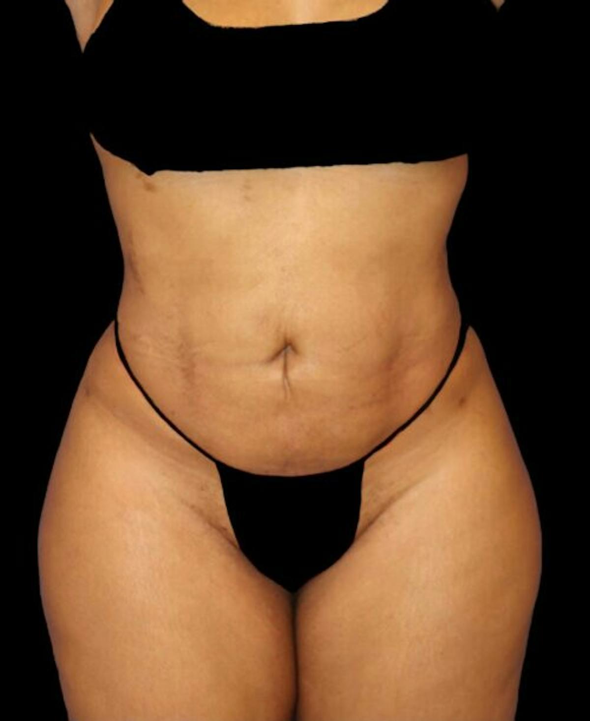 Dr. Kristy Hamilton liposuction after — Houston, TX