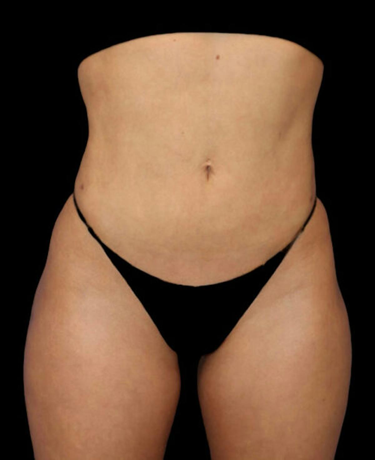 Dr. Kristy Hamilton liposuction after — Houston, TX