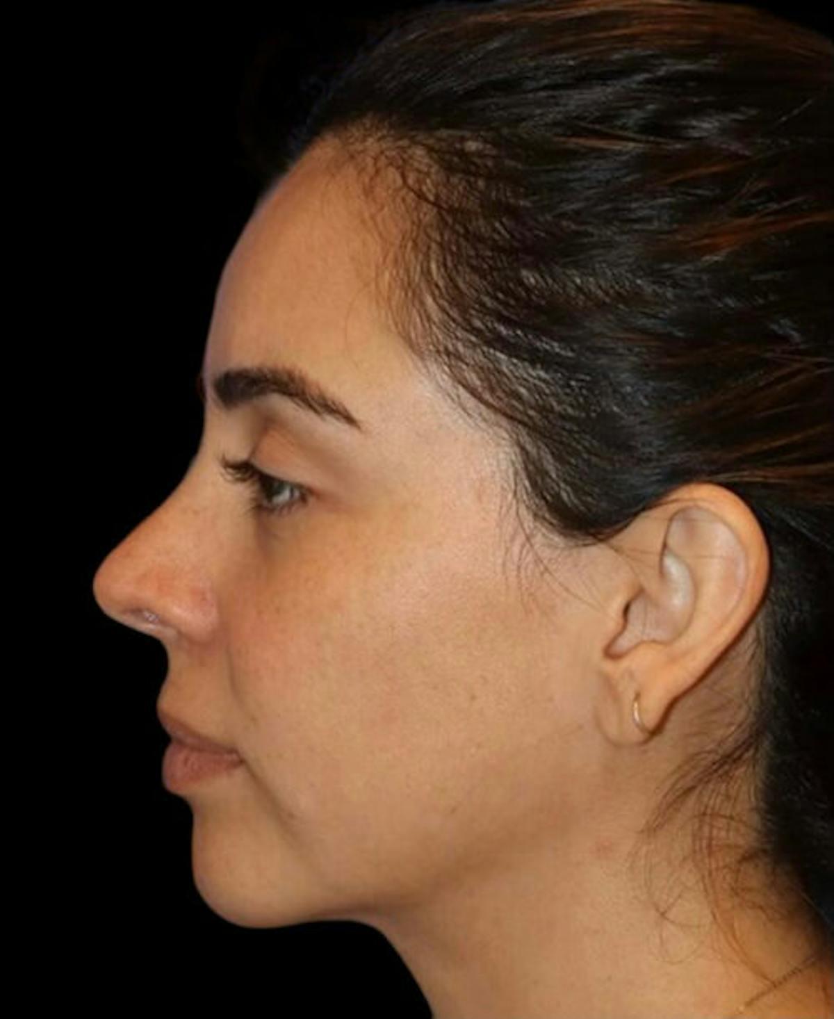 Dr. Kristy Hamilton rhinoplasty after — Houston, TX