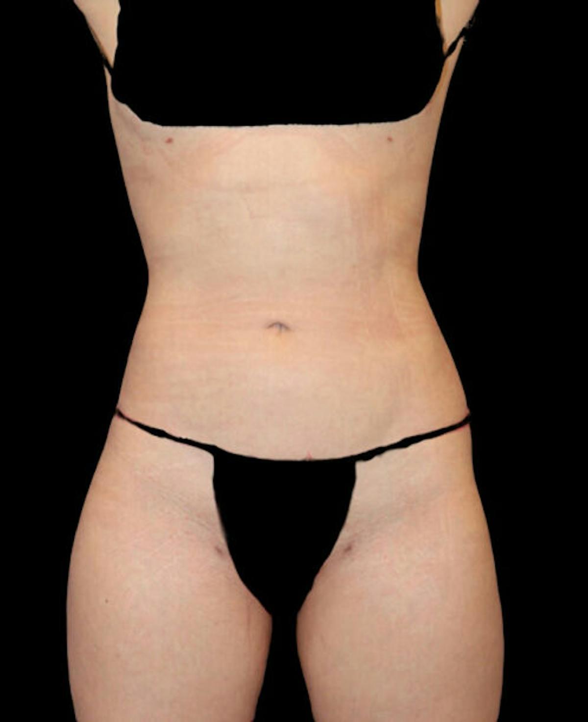 Dr. Kristy Hamilton liposuction after — Houston, TX