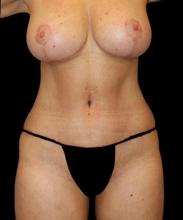 Mommy Makeover after at Dr. Kristy Hamilton in Houston, TX