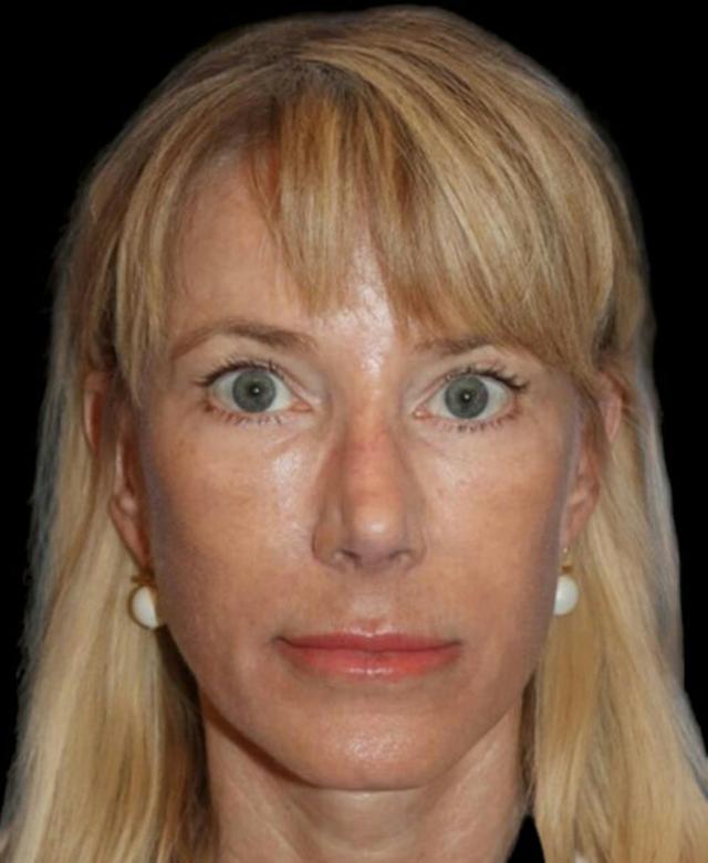 Neck Lift after at Dr. Kristy Hamilton in Houston, TX