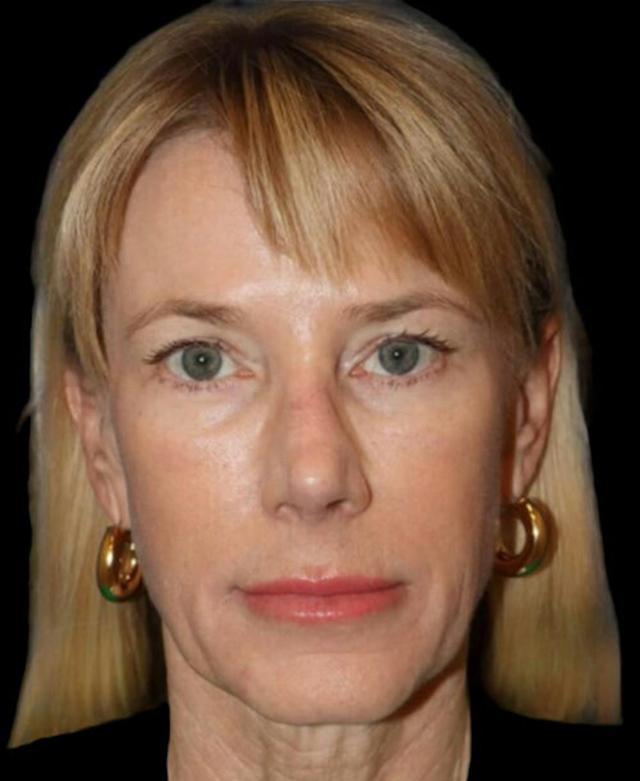 Neck Lift before at Dr. Kristy Hamilton in Houston, TX