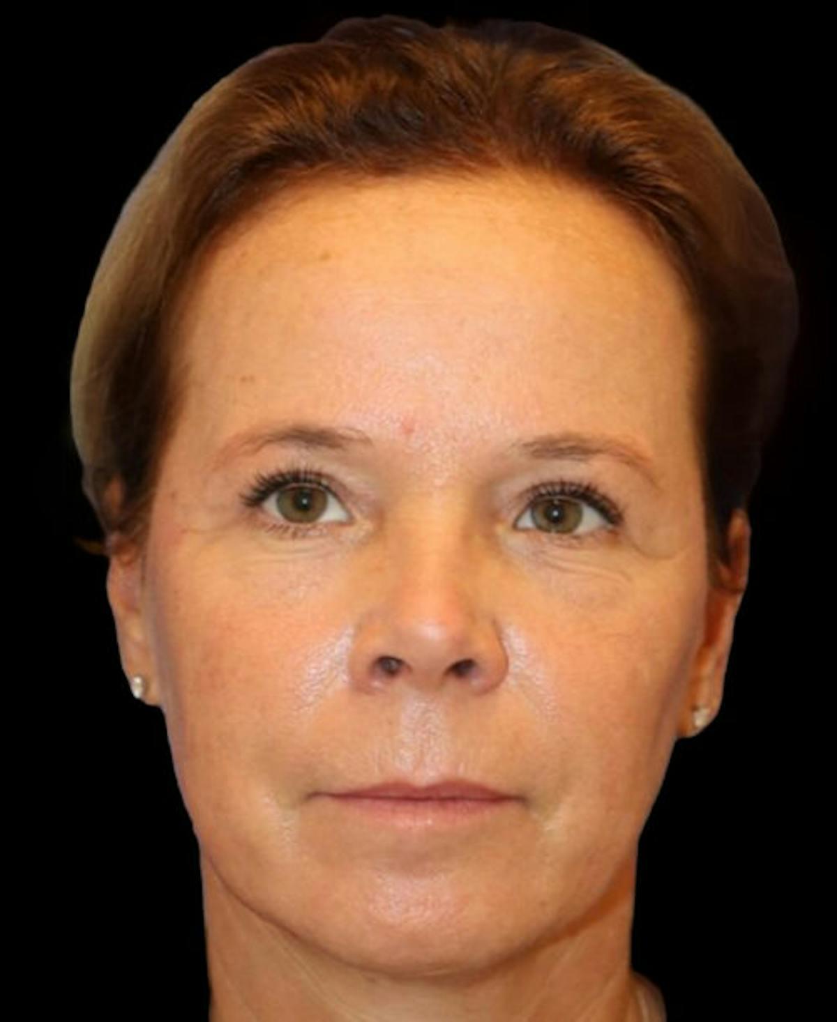 Dr. Kristy Hamilton blepharoplasty after — Houston, TX