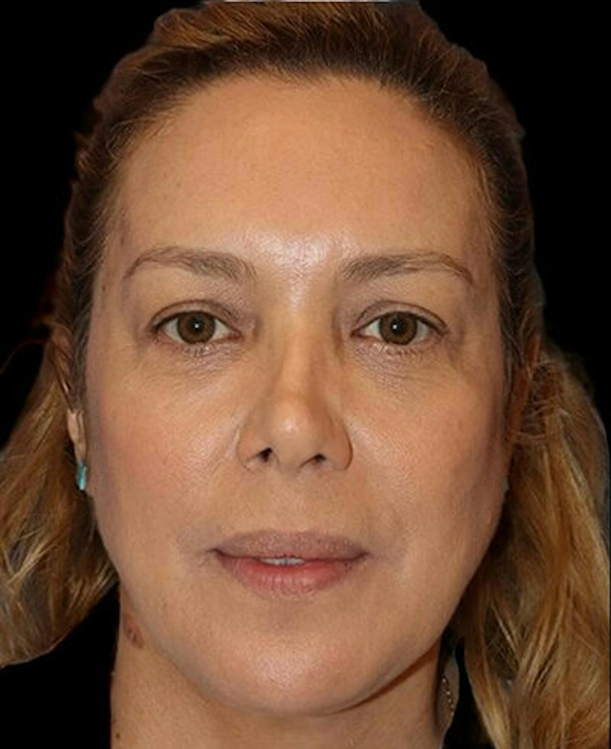 Dr. Kristy Hamilton blepharoplasty after — Houston, TX