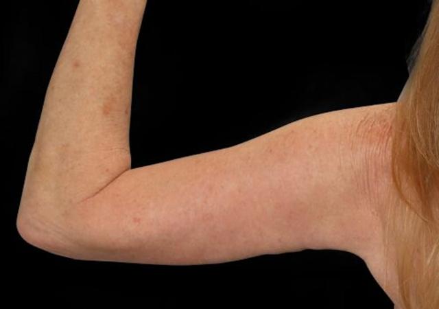 Arm Lift after at Dr. Kristy Hamilton in Houston, TX