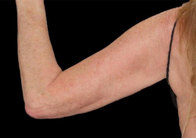 Arm Lift before at Dr. Kristy Hamilton in Houston, TX