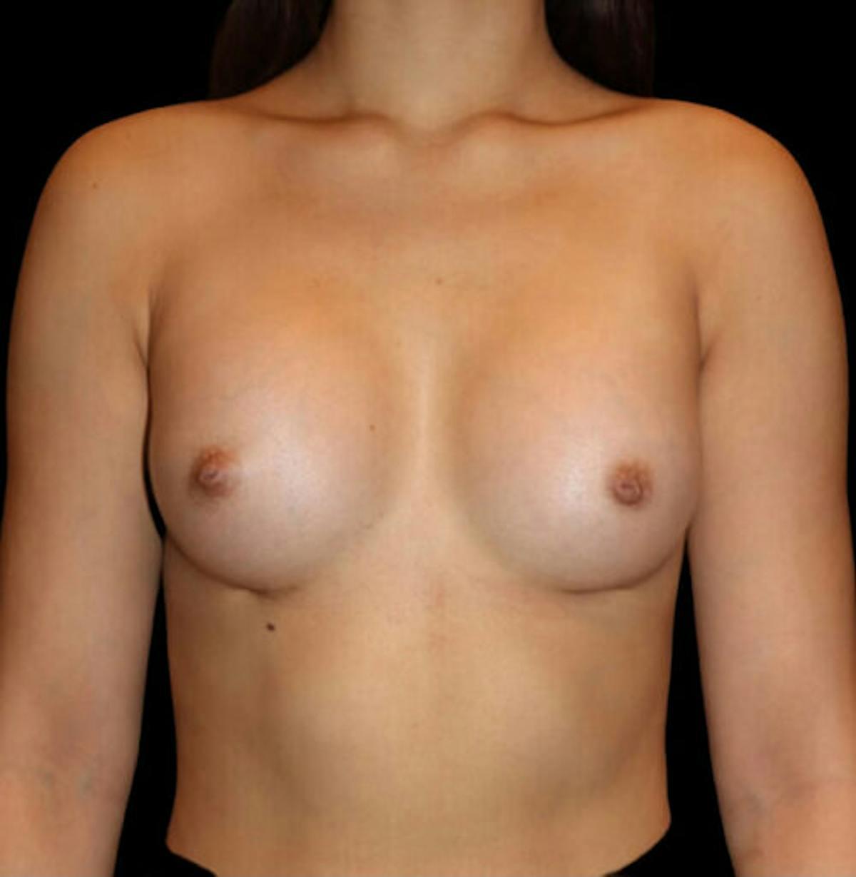 Dr. Kristy Hamilton breast augmentation after — Houston, TX
