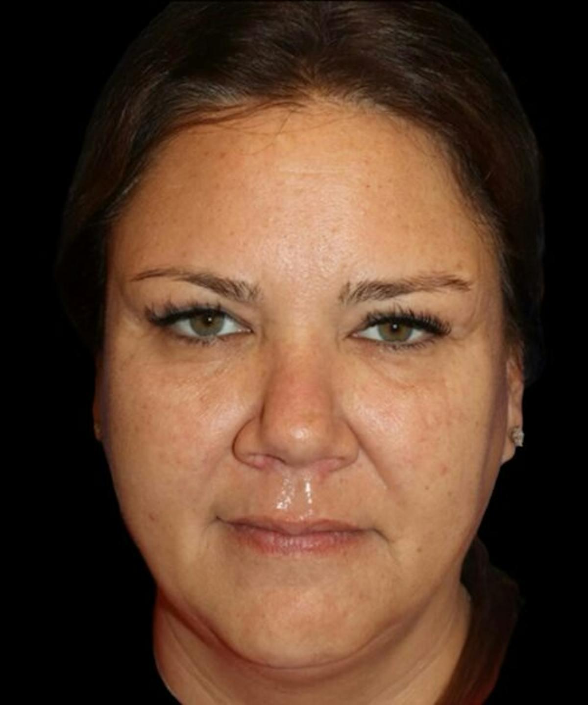 Dr. Kristy Hamilton blepharoplasty after — Houston, TX