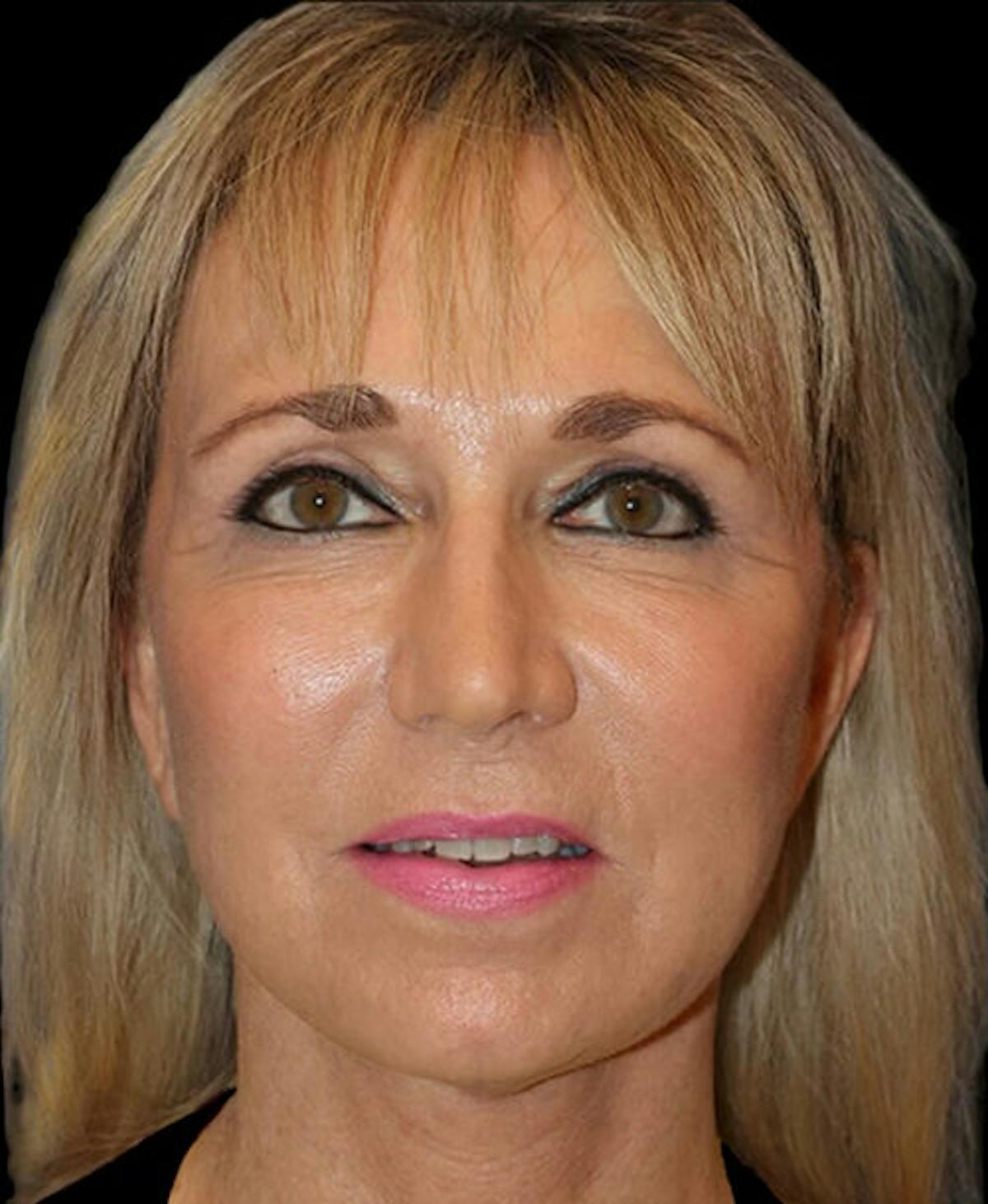 Dr. Kristy Hamilton blepharoplasty after — Houston, TX
