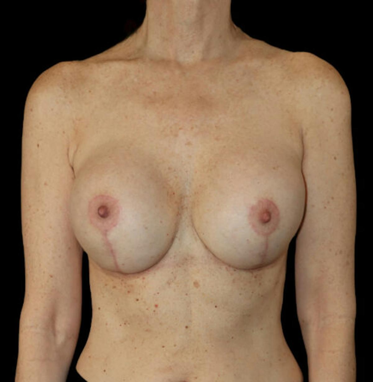 Dr. Kristy Hamilton breast augmentation after — Houston, TX