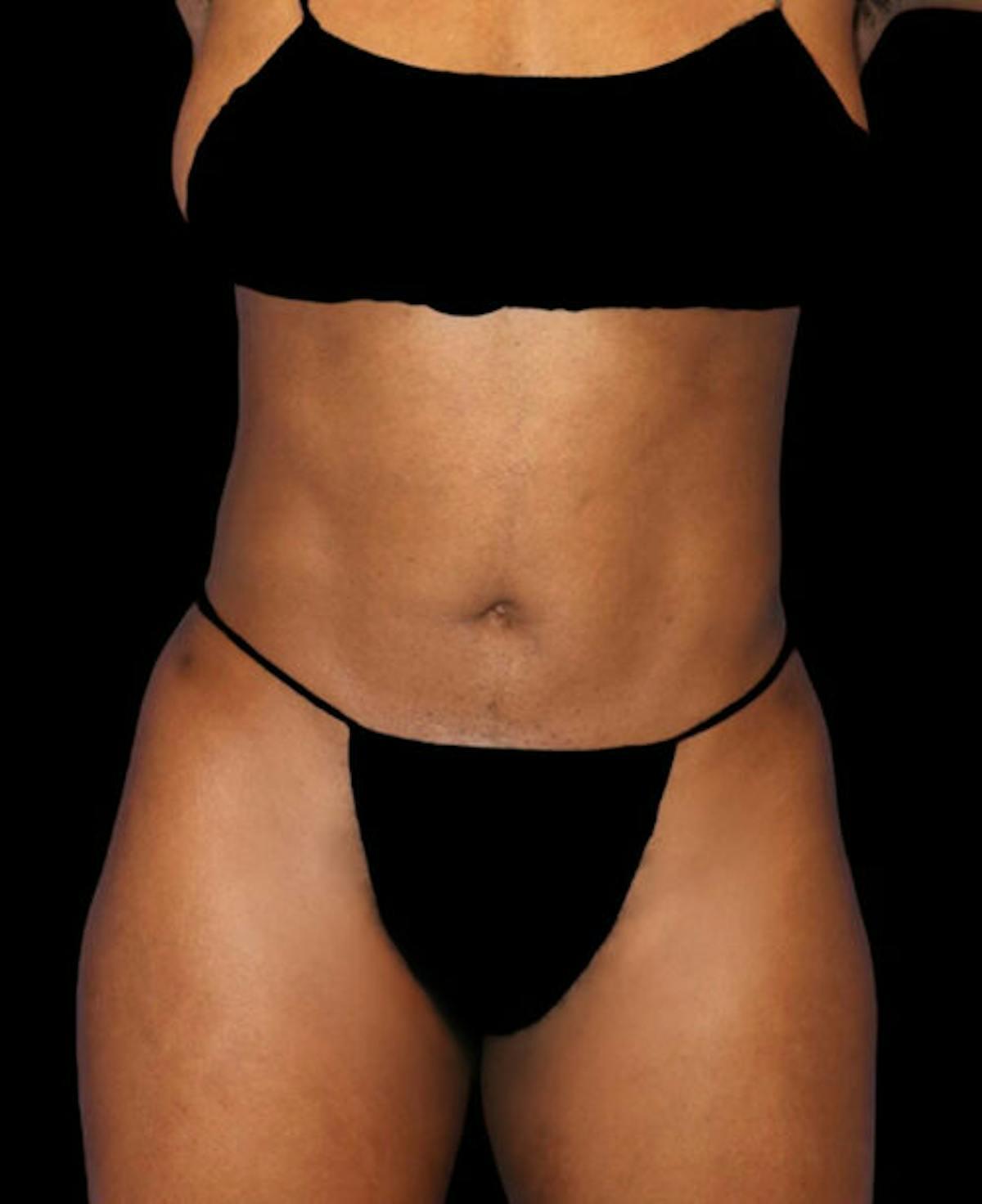 Dr. Kristy Hamilton liposuction after — Houston, TX