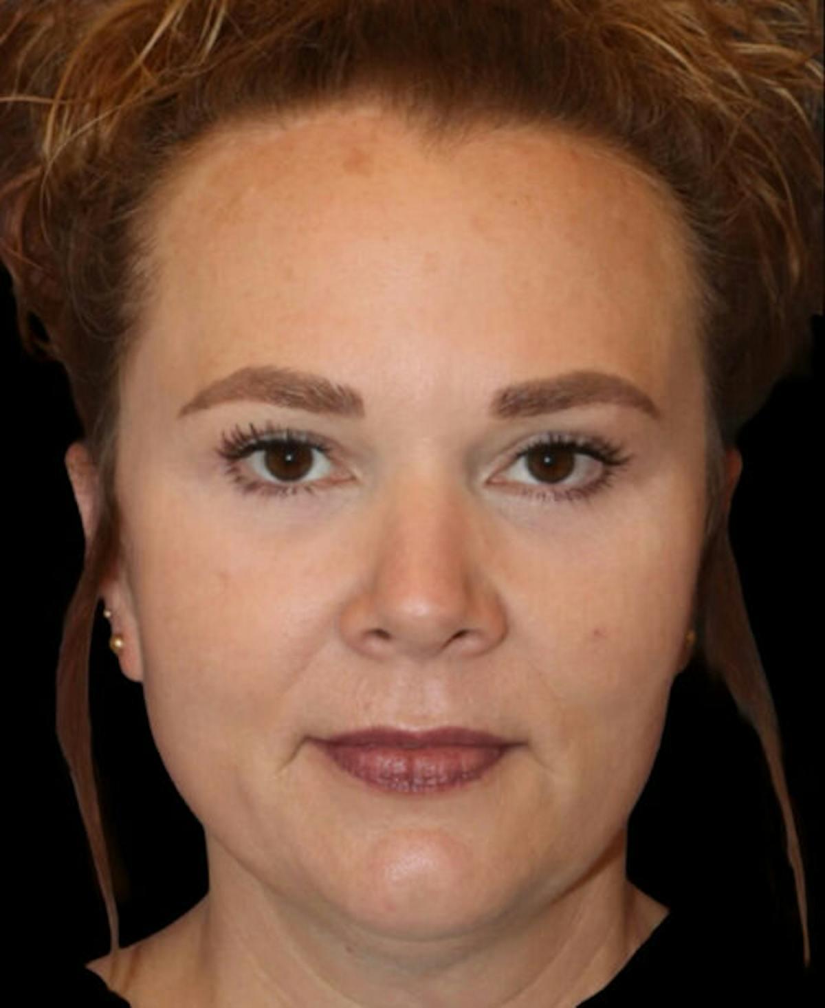 Dr. Kristy Hamilton blepharoplasty after — Houston, TX