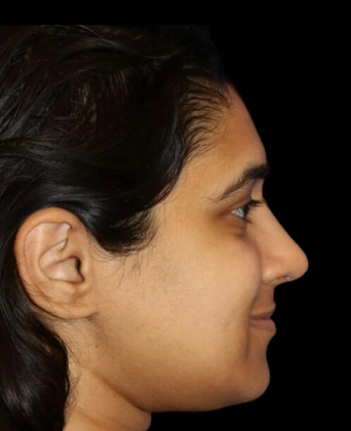 Dr. Kristy Hamilton rhinoplasty after — Houston, TX