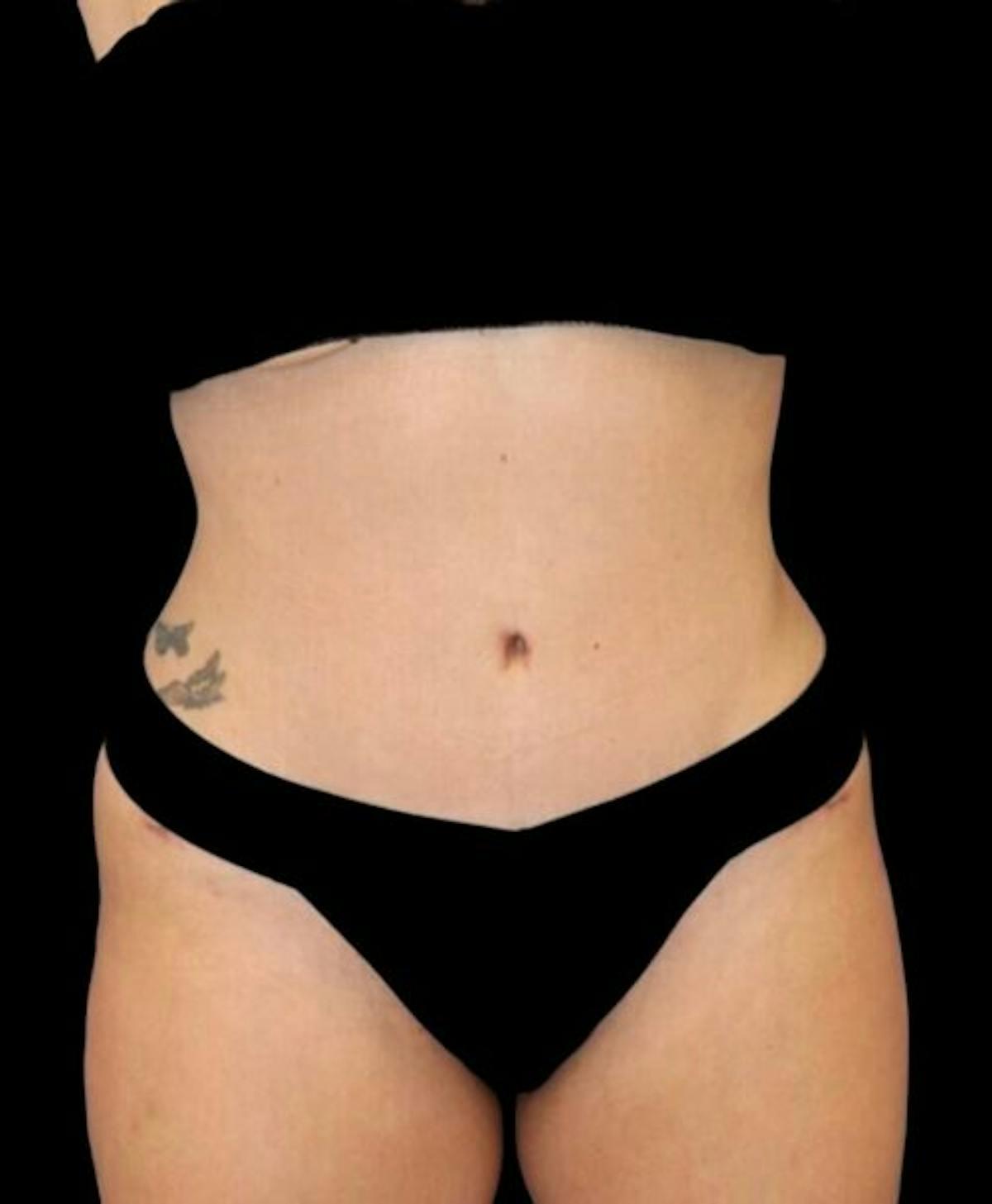 Dr. Kristy Hamilton tummy tuck after — Houston, TX