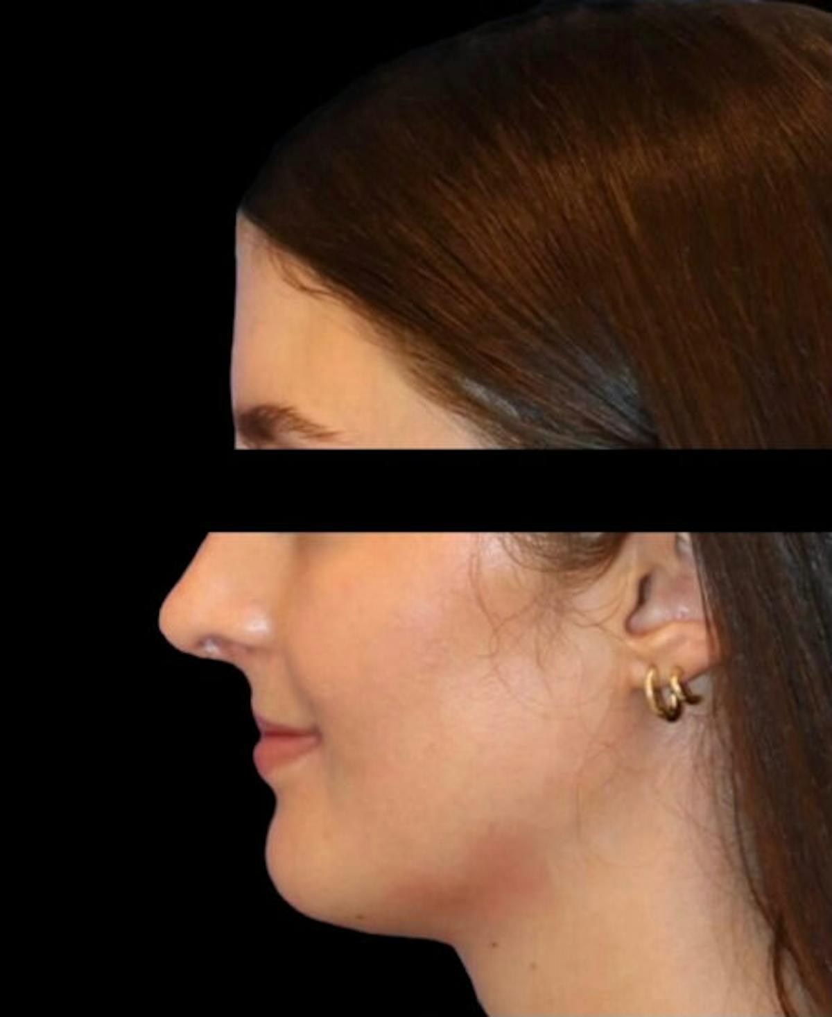 Dr. Kristy Hamilton rhinoplasty after — Houston, TX