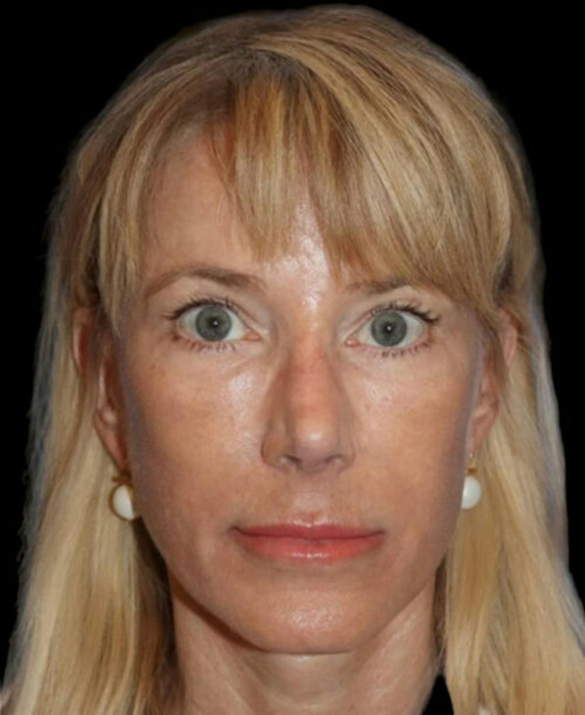 Dr. Kristy Hamilton facelift after — Houston, TX