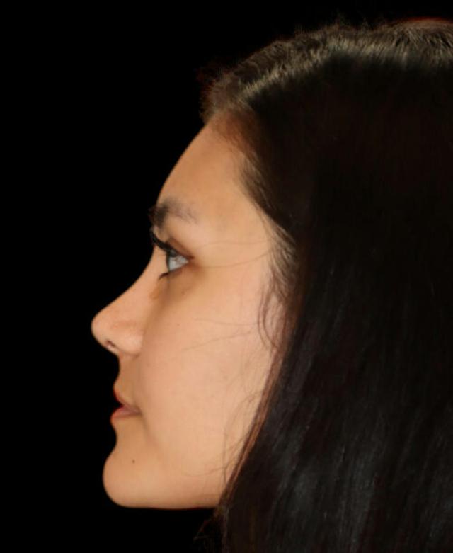 Liquid Rhinoplasty after at Dr. Kristy Hamilton in Houston, TX