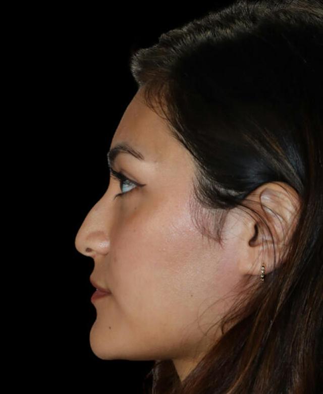 Liquid Rhinoplasty before at Dr. Kristy Hamilton in Houston, TX