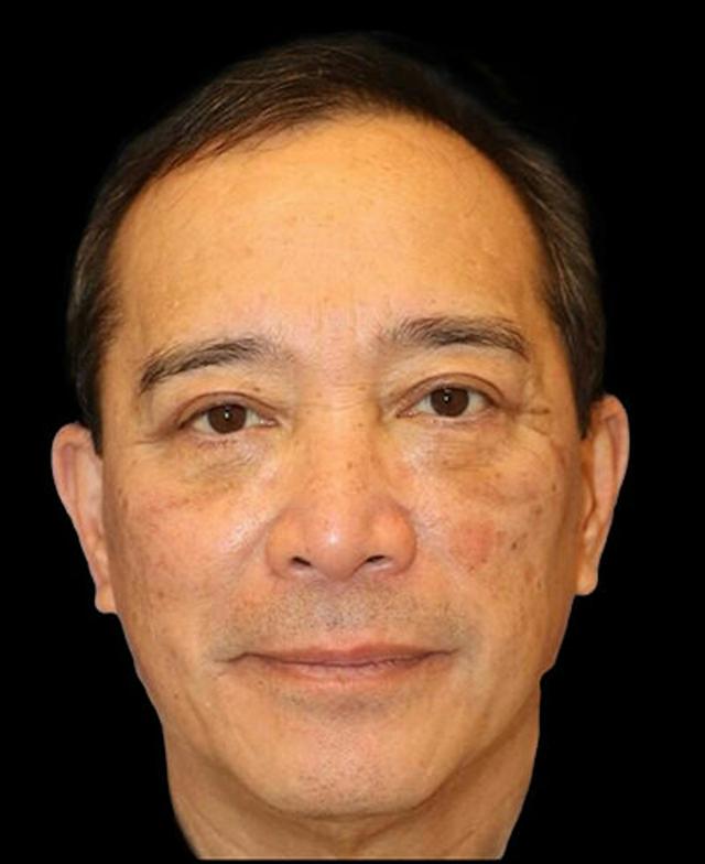 Blepharoplasty after at Dr. Kristy Hamilton in Houston, TX