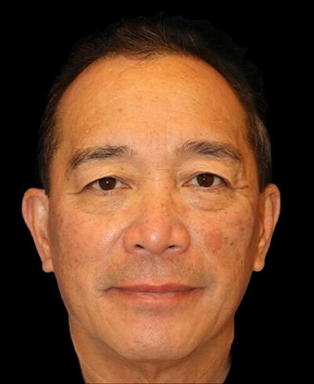 Blepharoplasty before at Dr. Kristy Hamilton in Houston, TX