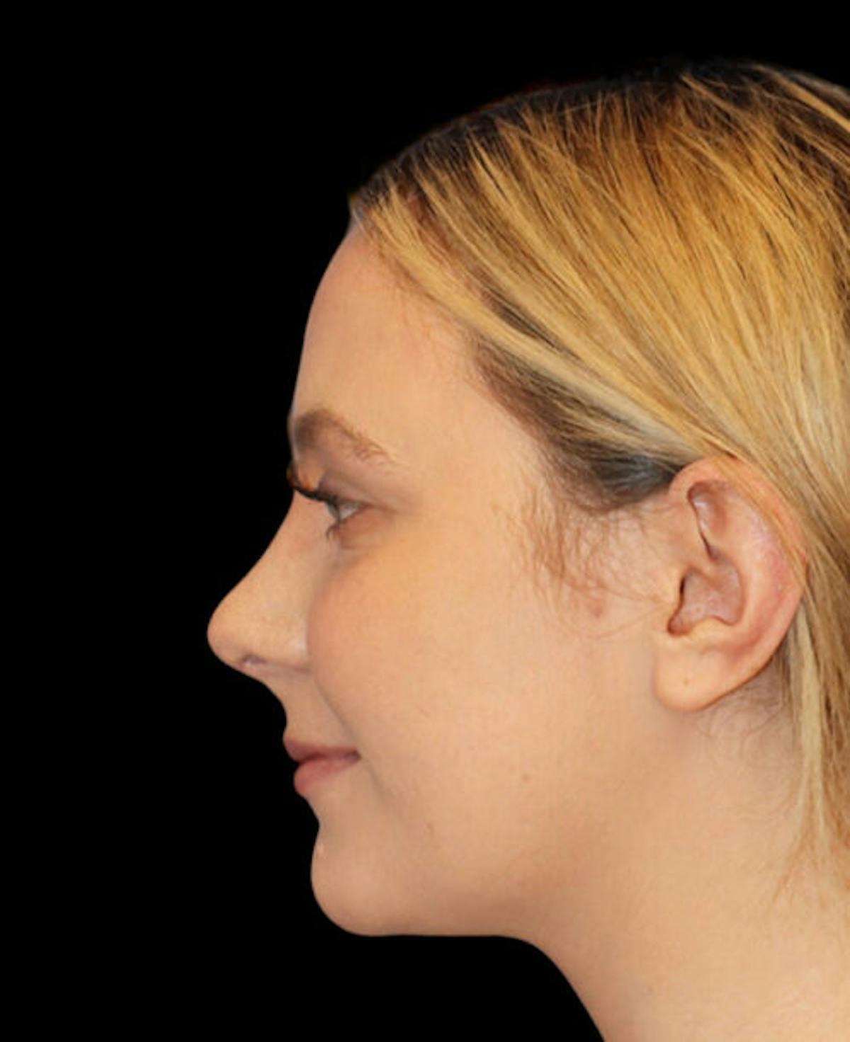 Dr. Kristy Hamilton rhinoplasty after — Houston, TX