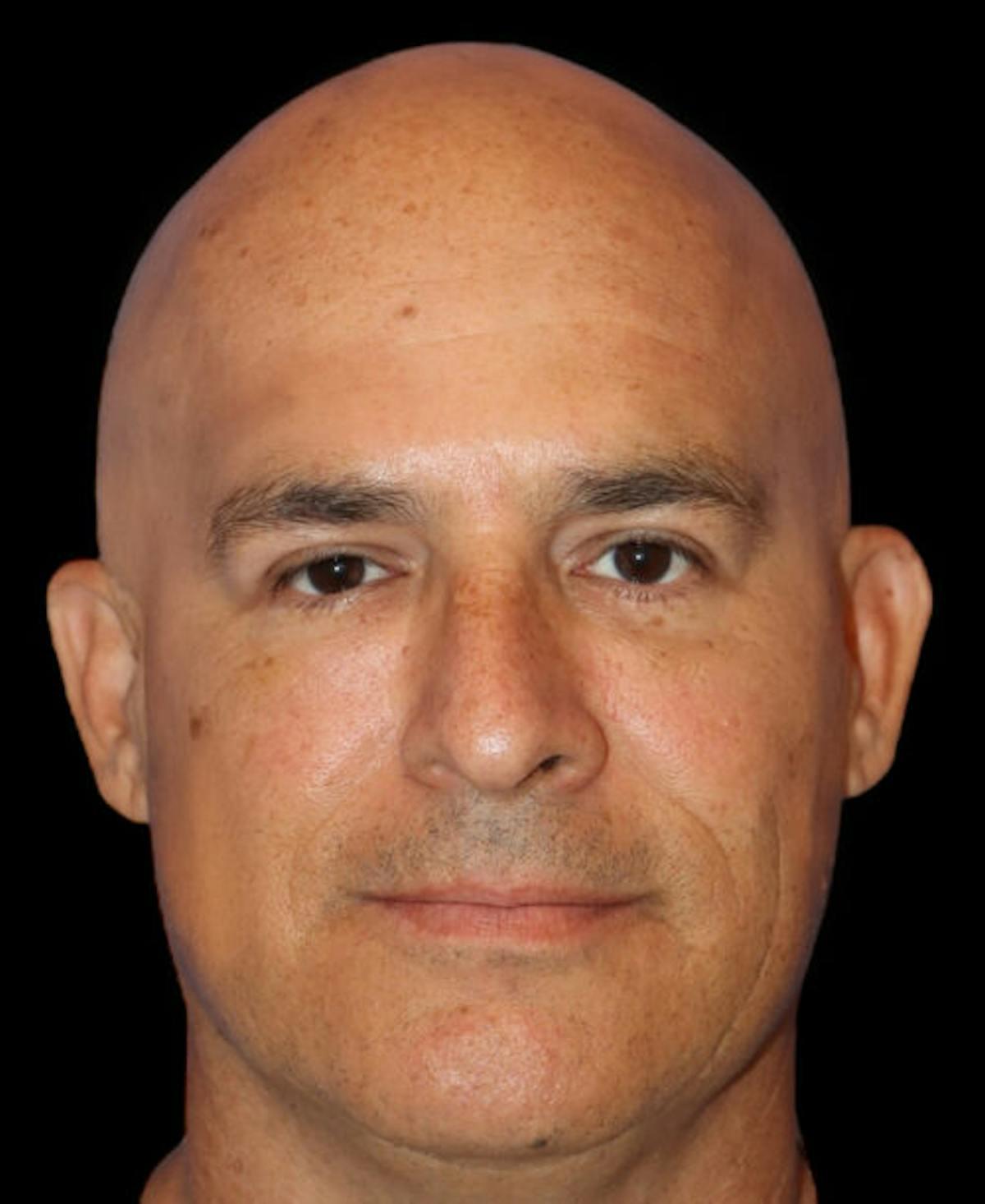Dr. Kristy Hamilton blepharoplasty after — Houston, TX